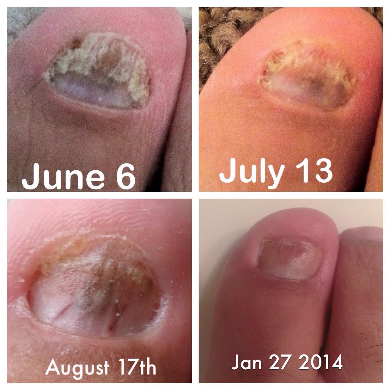 is lamisil good for toe fungus